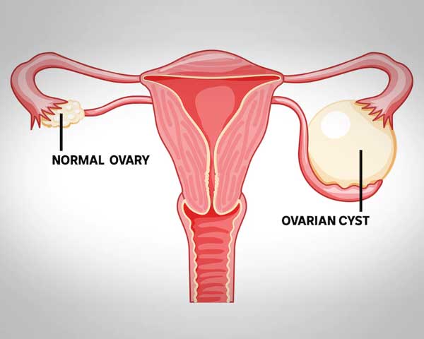 Ovarian Cyst
