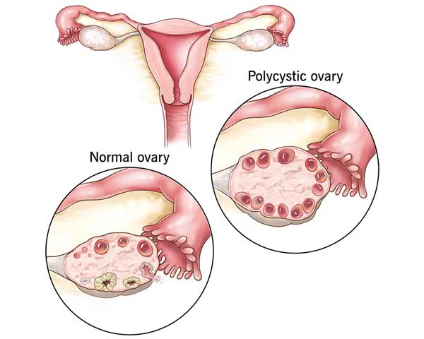PCOS