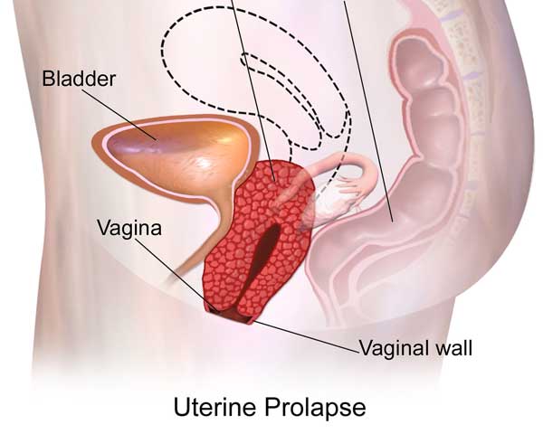 Uterine Prolapse